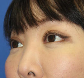 40代女性の3Dリポアイリフト  After 症例写真