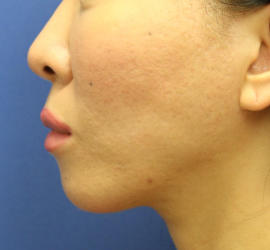 40代女性の3Dリポアイリフト  After 症例写真