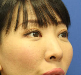 40代女性の3Dリポアイリフト  After 症例写真