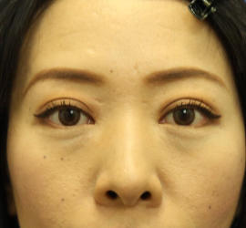 40代女性の目の下のクマ治療 Before 症例写真