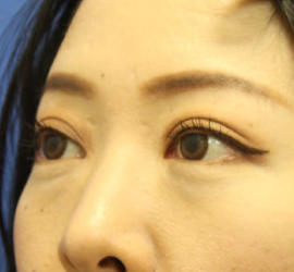 40代女性の3Dリポアイリフト  Before 症例写真