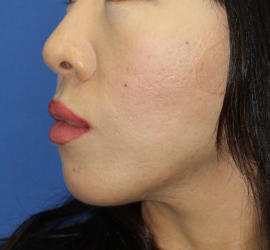 40代女性の3Dリポアイリフト  Before 症例写真