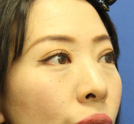 40代女性の3Dリポアイリフト  Before 症例写真