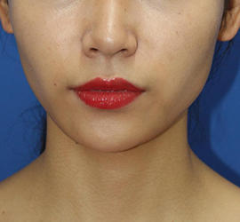 20代女性のメーラーファット除去 After 症例写真