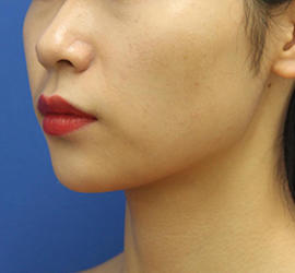 20代女性のメーラーファット除去 After 症例写真