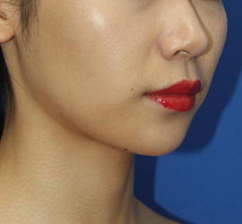 20代女性のエラ・アゴ・小顔 After 症例写真