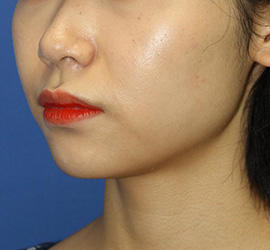 20代女性のメーラーファット除去 Before 症例写真