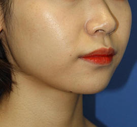 20代女性のエラ・アゴ・小顔 Before 症例写真