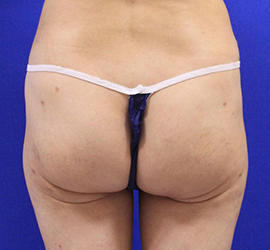 40代女性の脂肪吸引 After 症例写真
