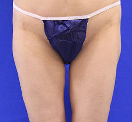 40代女性の脂肪吸引 After 症例写真