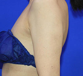 40代女性の脂肪吸引 After 症例写真