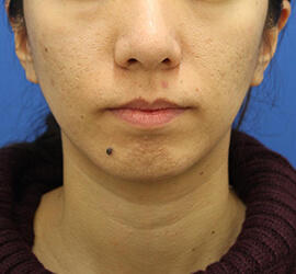 20代女性の小林式ニキビ治療法 After 症例写真