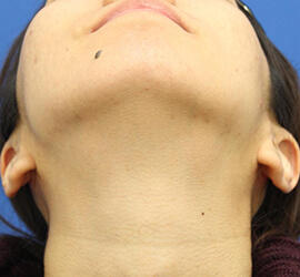 20代女性の小林式ニキビ治療法 After 症例写真