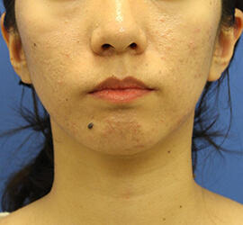 20代女性の小林式ニキビ治療法 Before 症例写真
