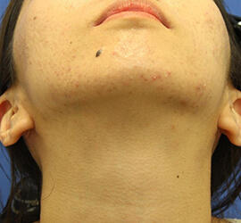 20代女性の小林式ニキビ治療法 Before 症例写真