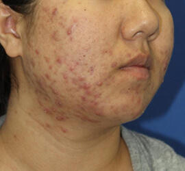 20代女性の小林式ニキビ治療法 Before 症例写真