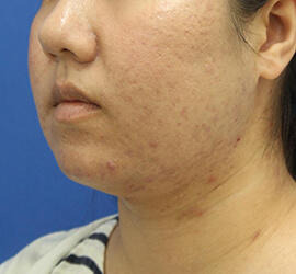 20代女性の小林式ニキビ治療法 After 症例写真