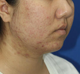 20代女性の小林式ニキビ治療法 After 症例写真