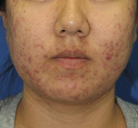 20代女性の小林式ニキビ治療法 Before 症例写真