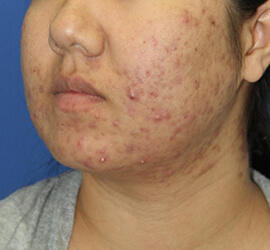 20代女性の小林式ニキビ治療法 Before 症例写真