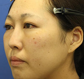 20代女性の3Dリポアイリフト  After 症例写真