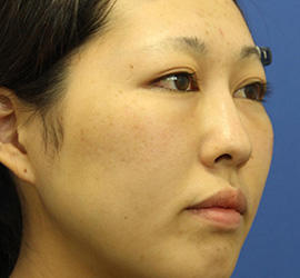 20代女性の3Dリポアイリフト  After 症例写真