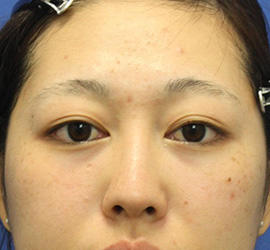 20代女性の目の下のクマ治療 After 症例写真
