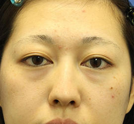 20代女性の目の下のクマ治療 Before 症例写真