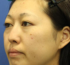 20代女性の3Dリポアイリフト  Before 症例写真