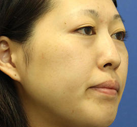 20代女性の3Dリポアイリフト  Before 症例写真