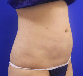 20代女性の脂肪吸引 After 症例写真