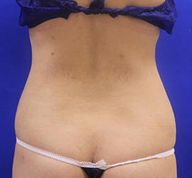 20代女性の脂肪吸引 After 症例写真