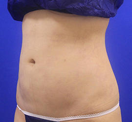 20代女性の脂肪吸引 After 症例写真