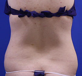 20代女性の脂肪吸引 Before 症例写真