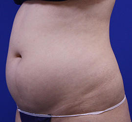 20代女性の脂肪吸引 Before 症例写真