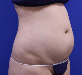 20代女性の脂肪吸引 Before 症例写真