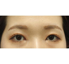 20代女性の二重整形・目元の整形 After 症例写真