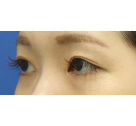 20代女性の全切開二重まぶた法 After 症例写真