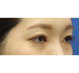 20代女性の全切開二重まぶた法 After 症例写真