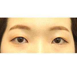 20代女性の二重整形・目元の整形 Before 症例写真