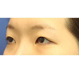 20代女性の全切開二重まぶた法 Before 症例写真