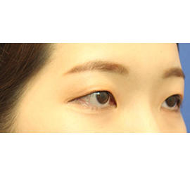 20代女性の全切開二重まぶた法 Before 症例写真