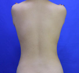 20代女性の脂肪吸引 After 症例写真