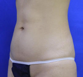 20代女性の脂肪吸引 After 症例写真