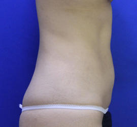 20代女性の脂肪吸引 After 症例写真