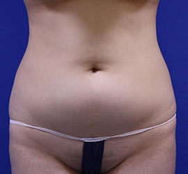 20代女性の脂肪吸引 Before 症例写真