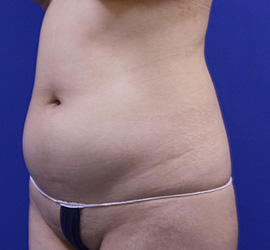 20代女性の脂肪吸引 Before 症例写真