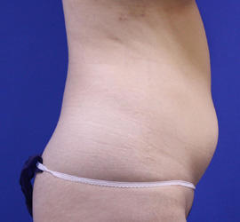 20代女性の脂肪吸引 Before 症例写真