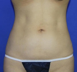 20代女性の脂肪吸引 After 症例写真