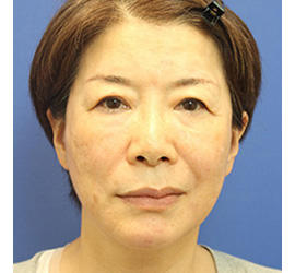 60代女性のヒアルロン酸骨格リフト After 症例写真